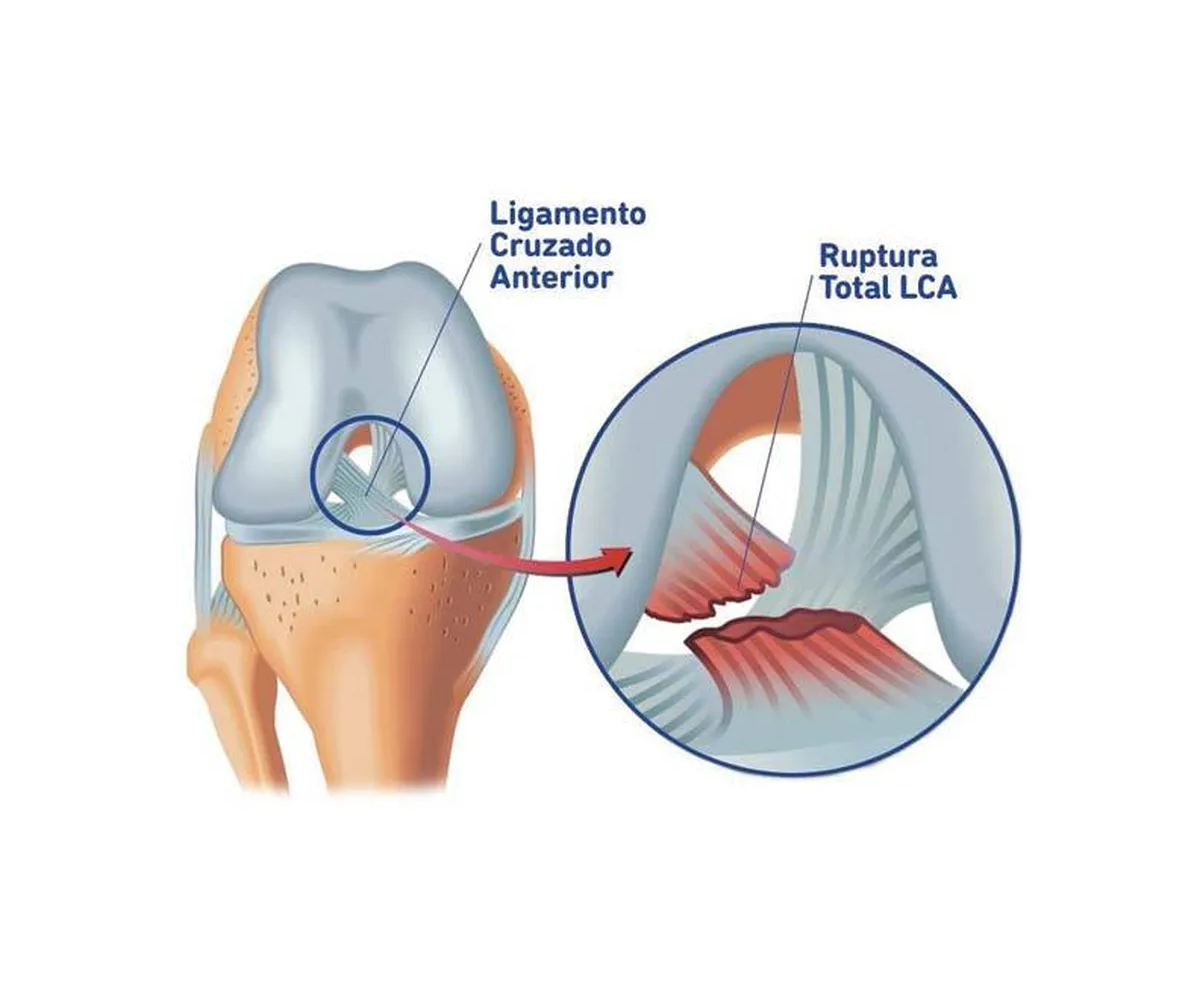Ligamento do Joelho