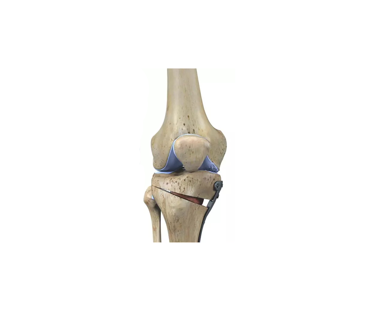 Osteotomias Femorais